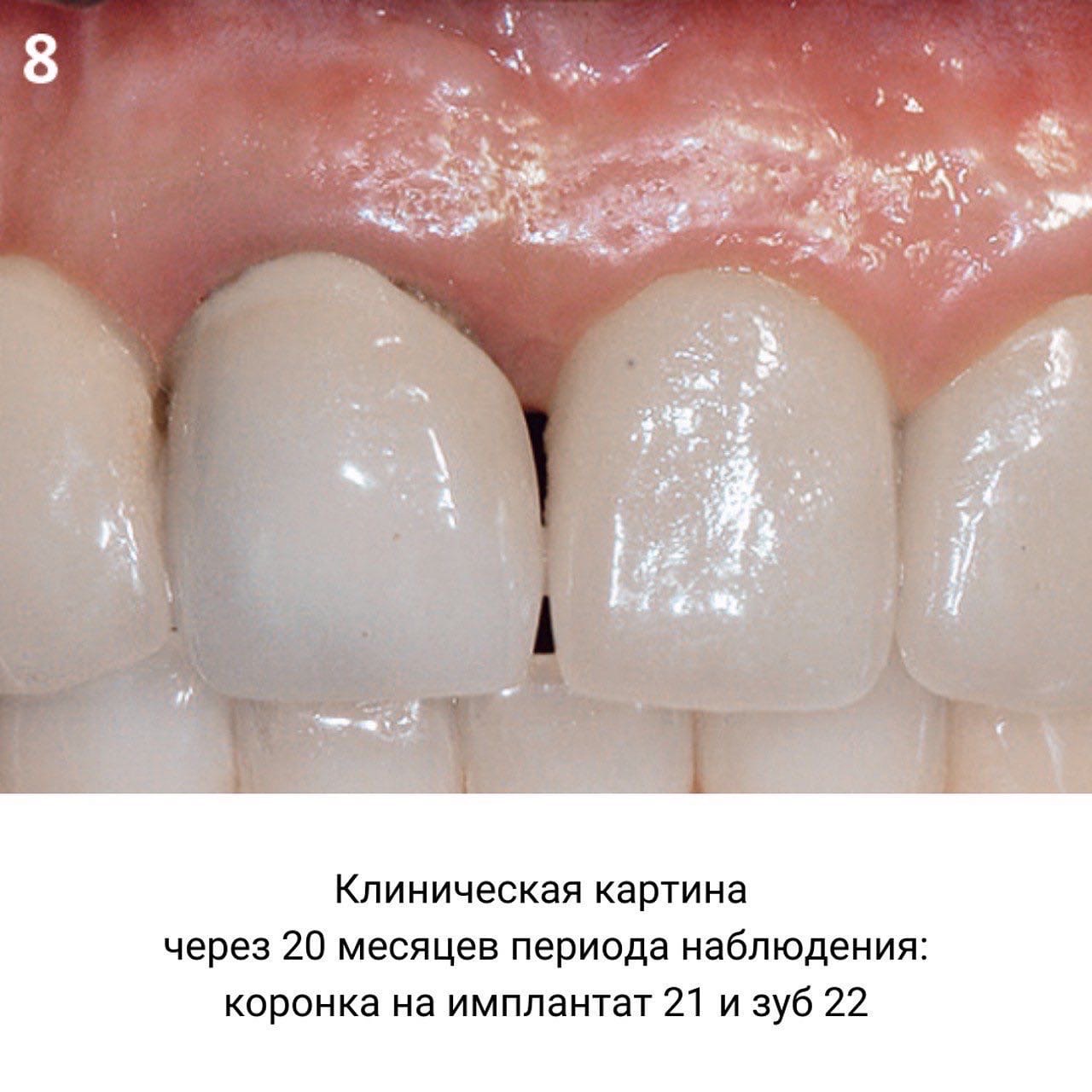 Лечение фенестрации и периапикального костного дефекта: кейс по клиническому случаю из практики Марелен Тео (Сингапур)